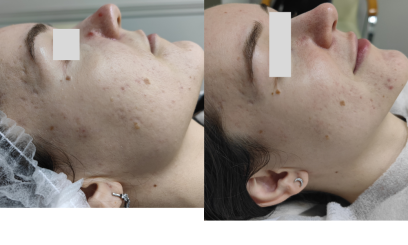 Авторский пилинг Себорегулирующий 2